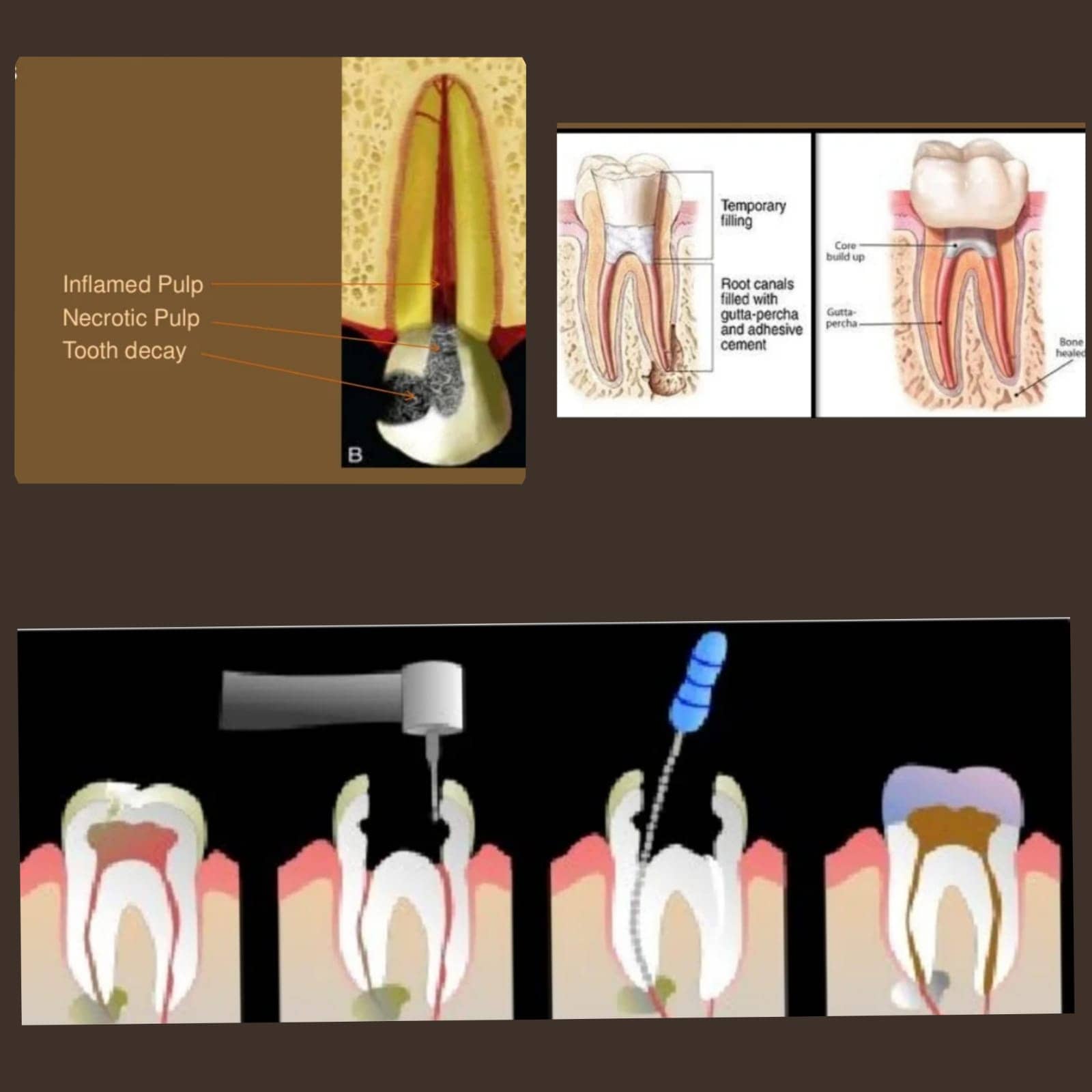 Need to Know About a Root Canal Treatment or RCT